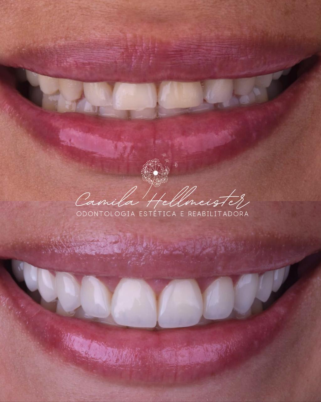 Facetas de Resina Composta + Contorno Gengival