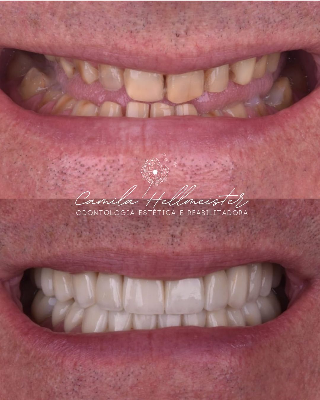 Reabilitação Oral + Porcelana