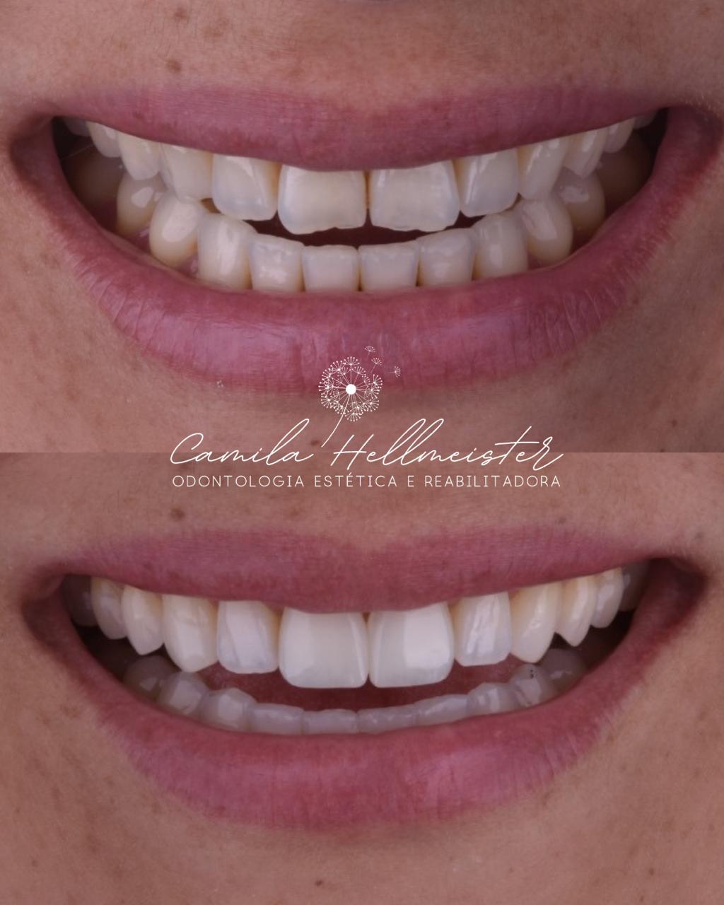 Facetas de Resina Composta