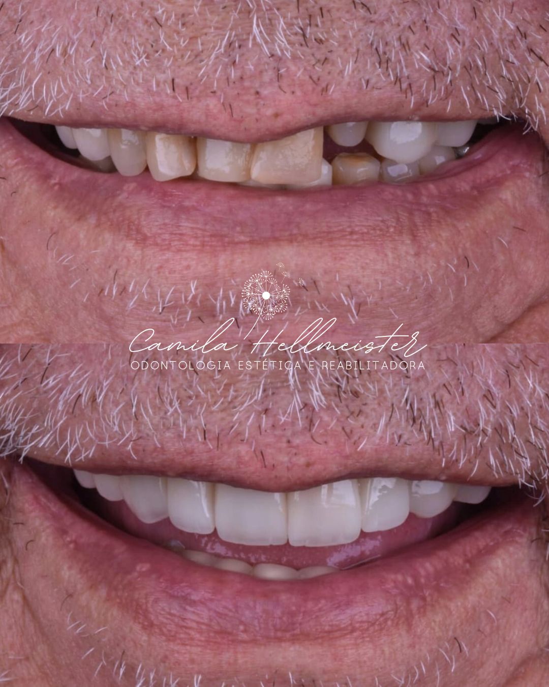 Reabilitação Estética por Etapas