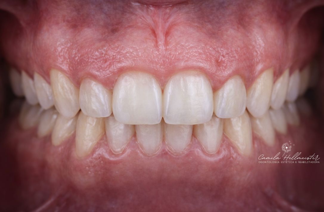 Plástica Gengival - Resultado